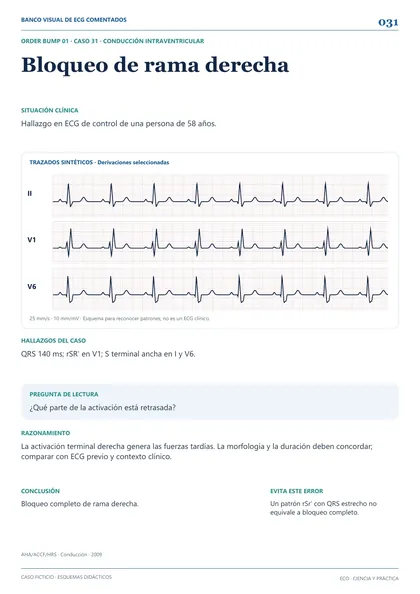 Muestra de ECG: bloqueo de rama derecha